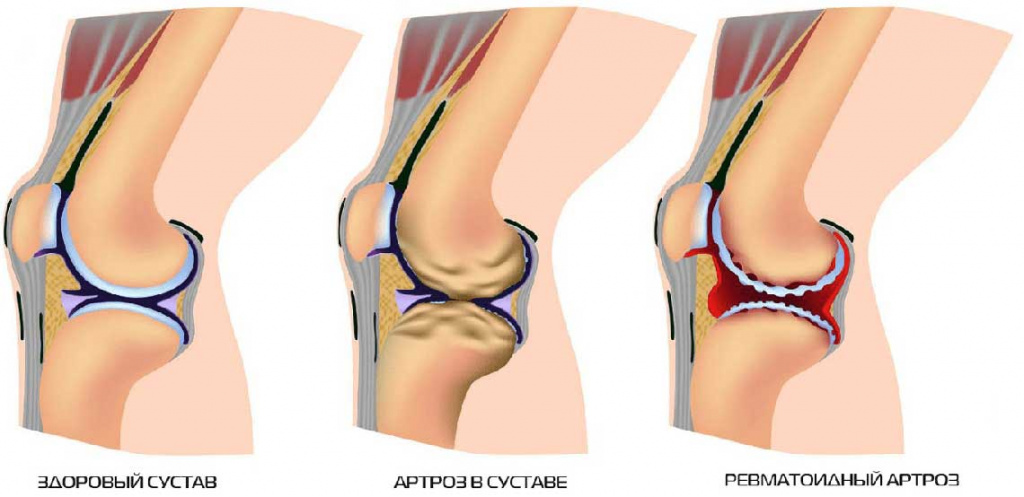 analize pt artroza durere la glezna de sub genunchi