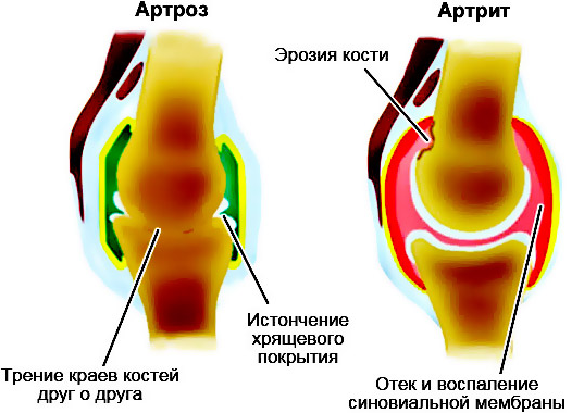 Артрит или артроз ног