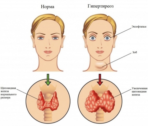 Проявления гипертиреоза