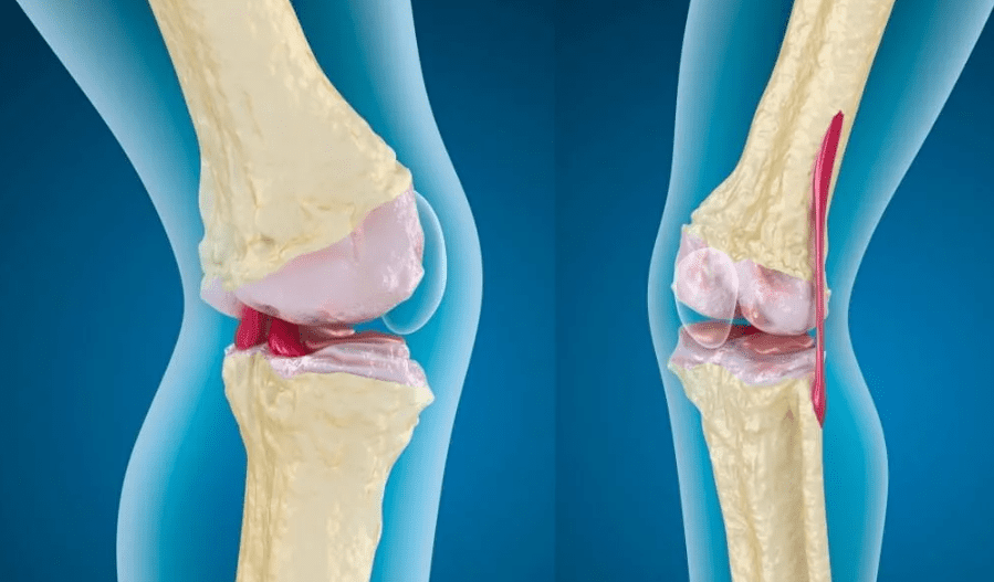 artroza piciorului tratamentului articular umflarea articulației piciorului și a gleznei