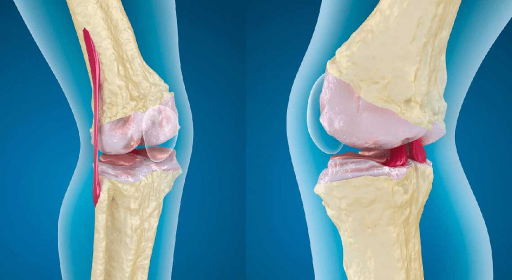 Мазь для суставов при артрозе коленных суставов