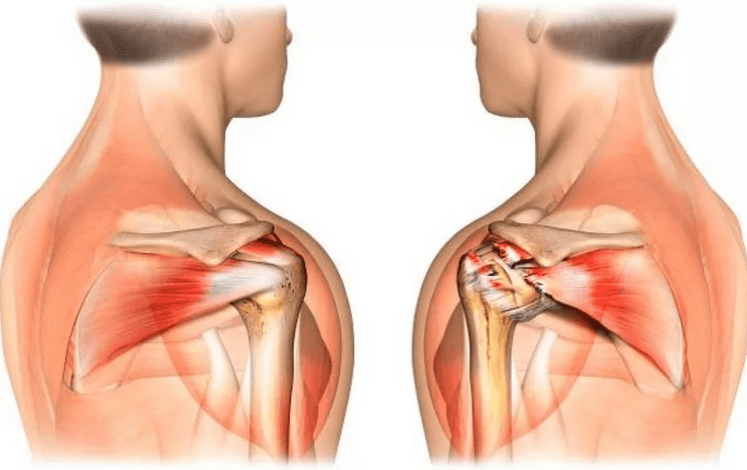Лечение боли в плечевом суставе